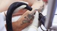 Laser Tattoo Removal | Tattoo Removal Cost | ProSkin Clinics