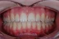 Teeth Whitening Newcastle | Teeth Whitening North East Whitley Bay ...