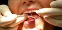 Fears raised over level of tooth extractions in Bradford children ...