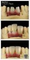 Before and after phoyos of cosmetic dentistry. | Dental Fact ...