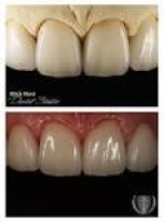 Want to change the appearance of one or more teeth? Veneers are ...