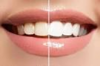 Dental Stains: The Basics