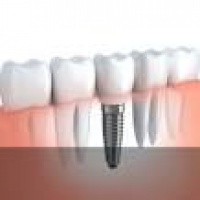 Dental Implants; Traetment